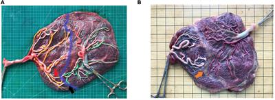 Effect of fetoscopic laser surgery on the placental characteristics and birth-weight discordance of twins with twin-to-twin transfusion syndrome